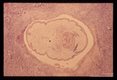 Human case. A cross section through the parasite shows typical tapeworm morphology. A dense neutrophilic infiltrate with many eosinophils is present in the adjacent muscle.