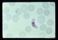 Crescentic gametocytes.