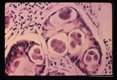 Human bowel. Five eggs in various stages of development are seen in the crypts of the bowel.
