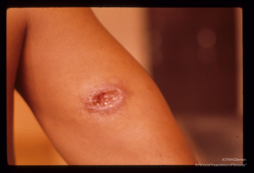 Ulcer at site of 3 week old Phlebotomus bite.