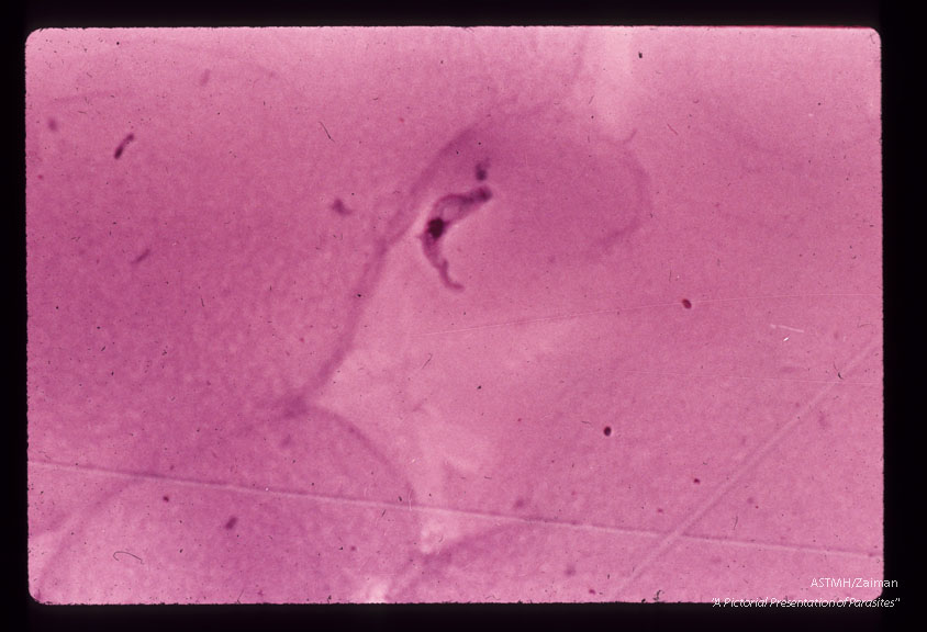 A seventy-one year old white male,  with a history of malaria 40 years earlier,  complained of weakness of three weeks duration following a vacation trip through Botswana,  South Africa in July and August of 1971.    During that trip he suffered many insect bites.    In September because of malaise,  chills and fever,  he started taking quinine.    A local physician subsequently prescribed quinine and Daraprim.    The chills and fever abated but weakness persisted. He became anorectic and lost weight. Physical examination in New York (Dr.  Hoskins) was remarkable for lethargy,   mild cnoephalopathy on HIP testing but no localizing signs,  bilateral,  cervical,  axilary and inguinal lymphadenopathy. Laboratory examination revealed slight anemia,  and motile trypanosomes in the; peripheral blood     The spinal fluid was clear,  opening pressure 130mm.   H2O,  4RBC,   33WBC, 84% mono,   16% sugar,   58% protein.    Twenty eight motile trypanosomes   / mm3 were seen in the counting chamber. The patient was treated with Suramin and Mel B (Arsobal) . The parasitemia disappeared,  the CSF cleared.    The patient probably suffered a transient reaction to Mel B (AS1)   with muscle weakness,  proximal more than distal with decreasing vibratory sense and fine tremor.  In spinal fluid of same patient.