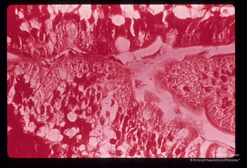 Trichrome stained peroral biopsy of duodenum showing trophozoites in close proximity to mucosa.