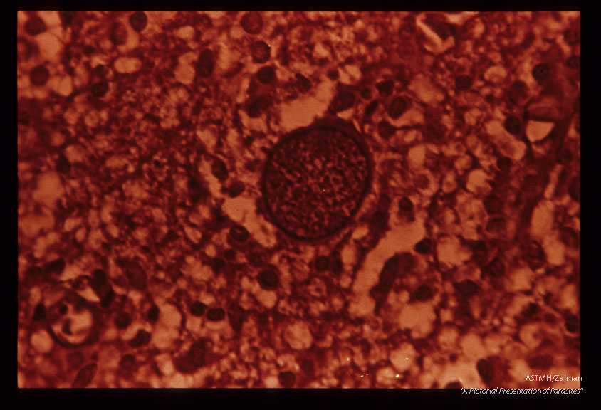 Cyst in human brain. Wilder's silver impregnation.