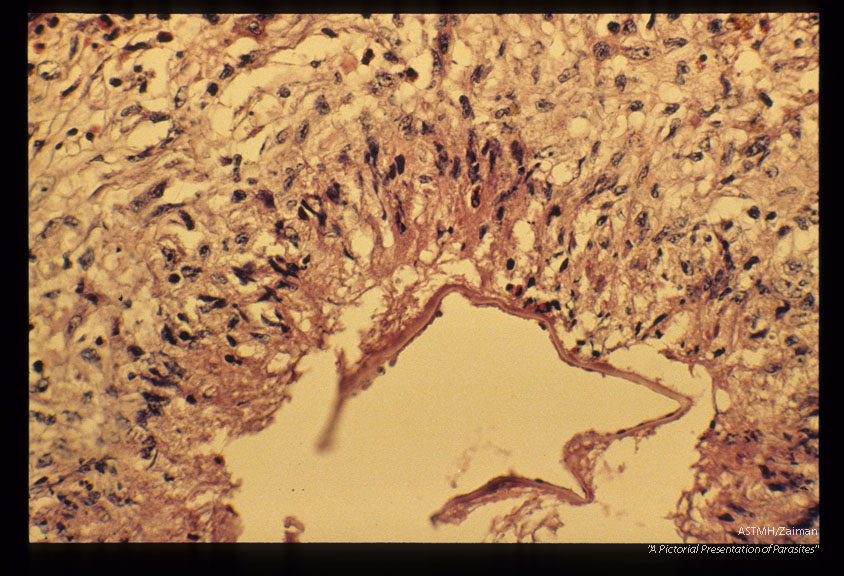 Gross and microscopic photos of human liver from Minnesota where about one half of the red foxes are infected.