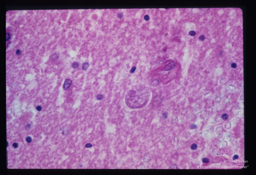 Brain showing glial proliferation and amoeba.