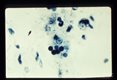 Trophozoites . iron hematoxylin stain. Each specimen has engulfed red blood cells which stain darkly.