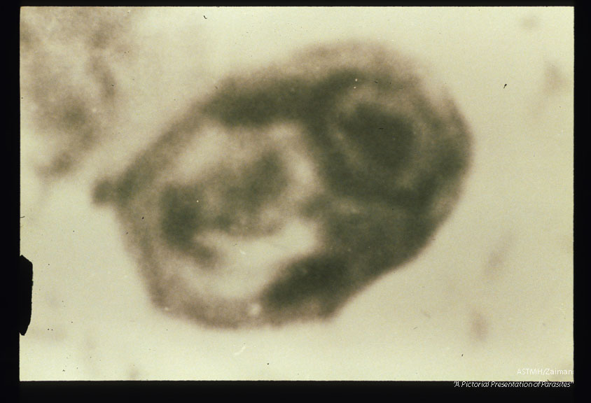 Cysts from patients in Venezuela.