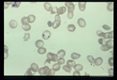Incorrectly diagnosed as Babesia until proven otherwise with specific stain for iron. (Prussian blue).