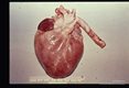 Heart showing typical pale, wet, flabby, swollen appearance due to myocarditis.