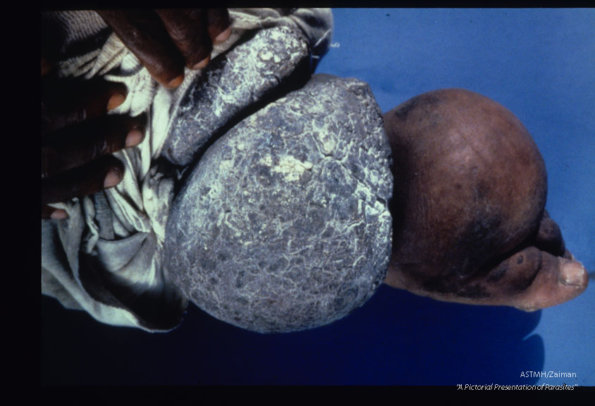 Elephantiasis of foot and heavily hyper- keratotic ankle lobules on left leg of a fifty-five year old male. Elephantiasis began twenty years earlier and the left leg is now enormously enlarged.