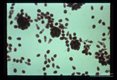 Hydatid sand. Numerous scolice some free, some in cysts accumulated at the low points of an hydatid cyst. When the free scolices evert, the suckers may protrude to give a cross-like appearance.