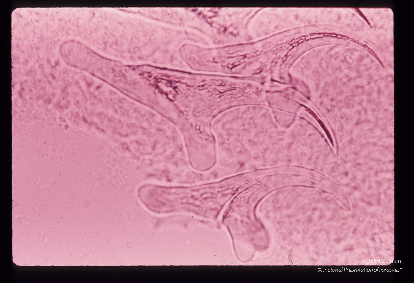 A 32 month old white male in South Dakota suffered progressive lassitude,   anorexia,   irritability,   incoordination and infrequent vomiting.  A suboccipital craniotomy was performed during which a grape-like mass of translucent thin wall cysts was discovered and partially evacuated with difficulty.  Subsequently patient developed flexion rigidity of the  extremities,  non-reactive pupils and decreased consciousness.  A sinus tract at the operative site con­tained more cysts.  The patient died three months after the onset of symptoms.  High power view of hooks.