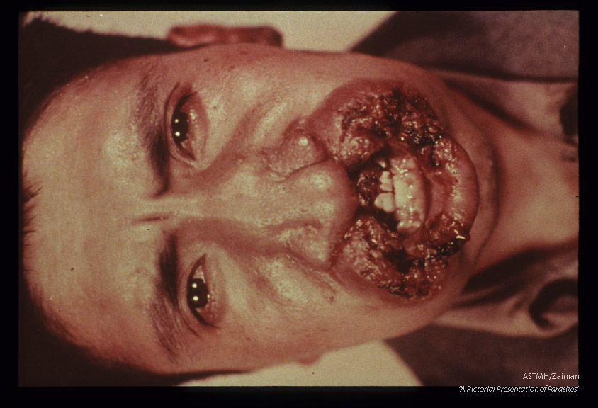 (South America). Three year old infection with involvement of naso-labial structures.