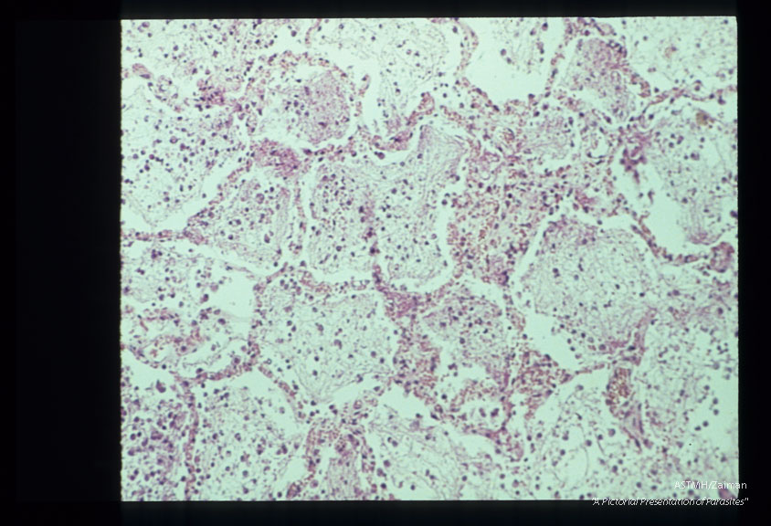 Pneumonia. The characteristic foamy alveolar exudate is well seen.