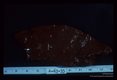 Human liver with a single visible pseudotubercle surrounded by hemorrhage.