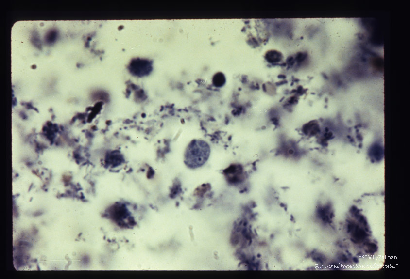 Cyst. Iron hematoxylin stain.