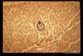 Heart showing hemorrhage and mesocercaria.