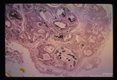 Adults in a lymphatic duct of the epididymis. The parasite presents as dark blue material in the upper portion of the picture.