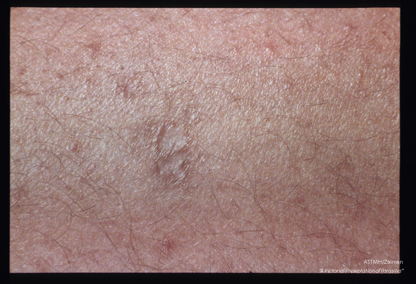 Healing skin lesion.