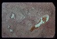 Portal fibrosis. Case of pipestem fibrosis (see slide 24).