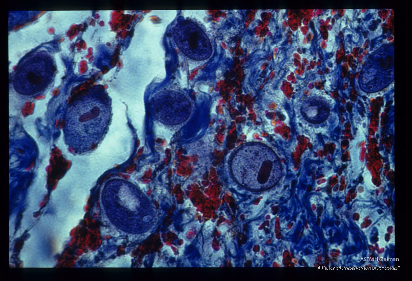 Costa Rica. This slide shows invasion of colon wall with associated hemorrhage. Red blood cells appear red with this Mallory Trichrome Stain.