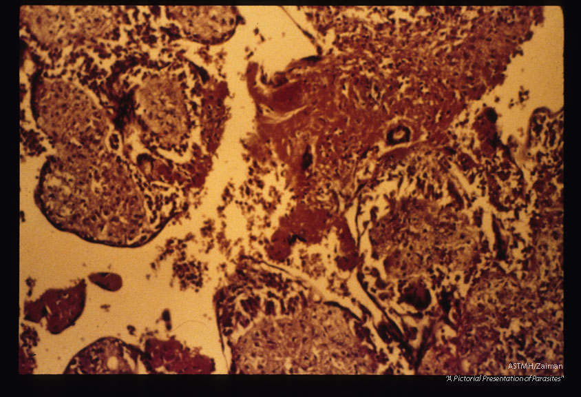 Granulomatous reaction in the placenta secondary to infection.