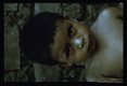 Romana's sign in Chagas'disease. Left periorbital region swollen.
