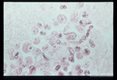 Meningitis- Hematoxylin-eosin stained section of human brain at various magnifications.