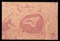 Adults in a mesenteric vein. Note the intimal thickening of the vein.