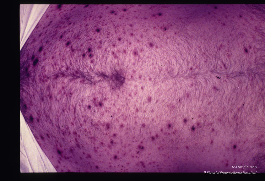 Dermatitis.