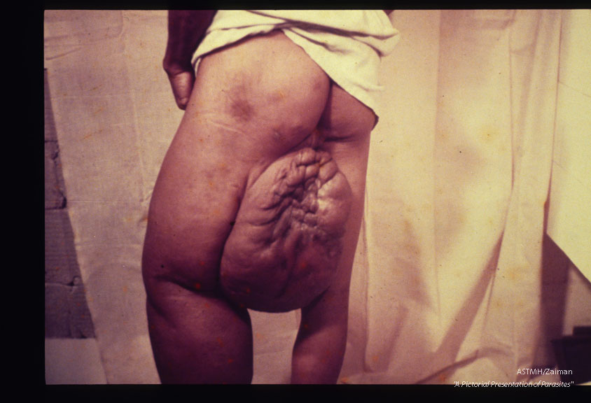 Anterior and posterior views of a patient in Venzuela.