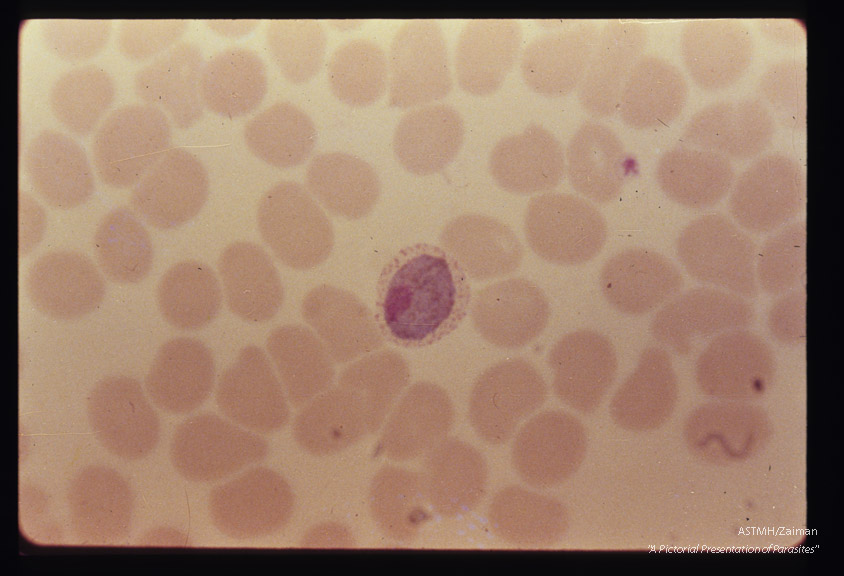 Gross pathology. Opened heart showing myocarditis in Chagas' disease.