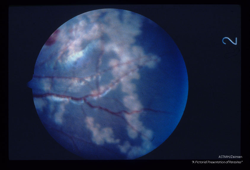 Fundus of a cynomolgus monkey showing inflammatory migratory tracks, sheathing of vessels, and focal hemorrhage 8 days after experimental infection.