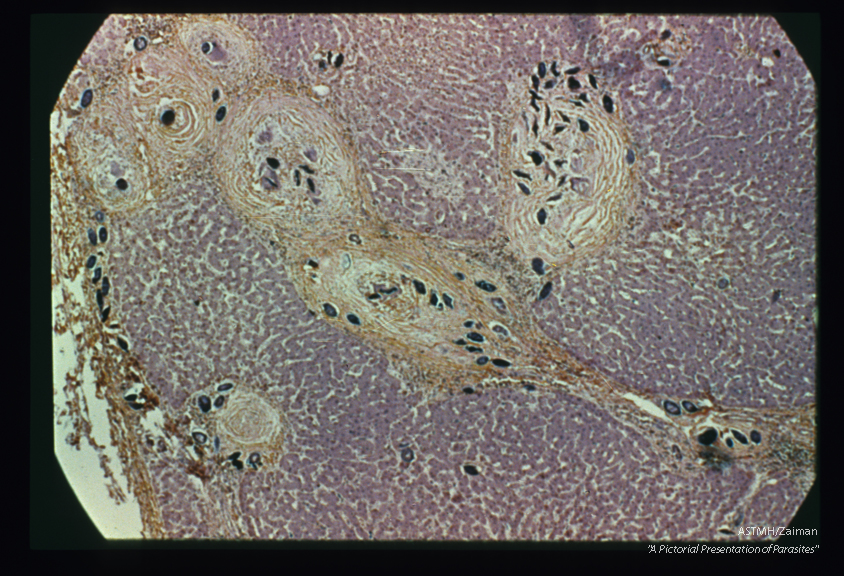 Fibrous reaction around eggs in liver. The eggs present as dark objects.